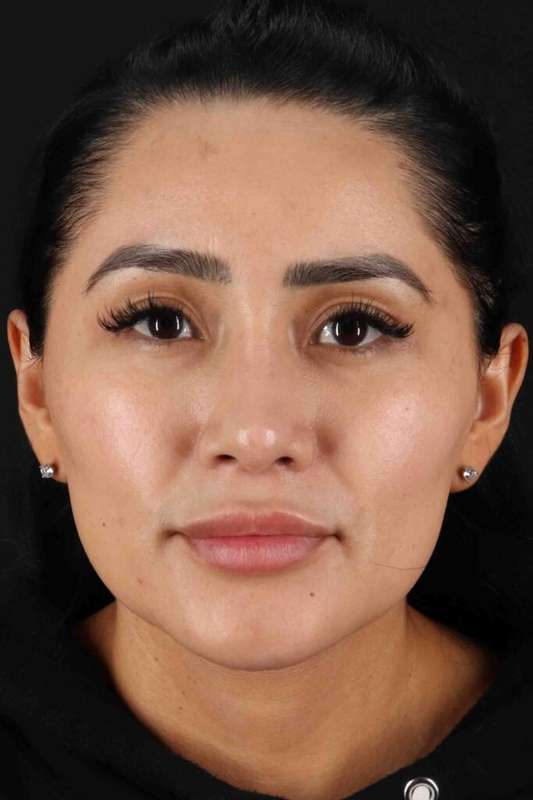 Rhinoplasty Before & After Patient #5925
