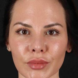 Rhinoplasty Before & After Patient #5936