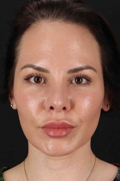 Rhinoplasty Before & After Patient #5936