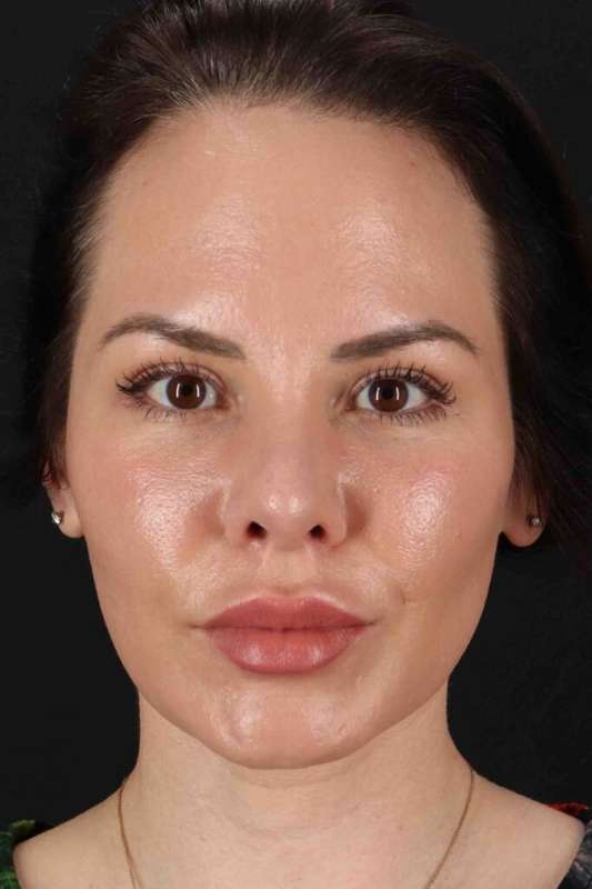 Rhinoplasty Before & After Patient #5936