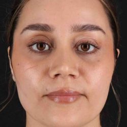 Rhinoplasty Before & After Patient #5947