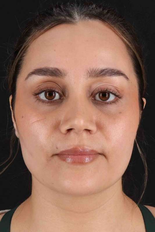 Rhinoplasty Before & After Patient #5947