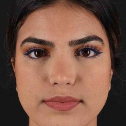 Rhinoplasty Before & After Patient #5958