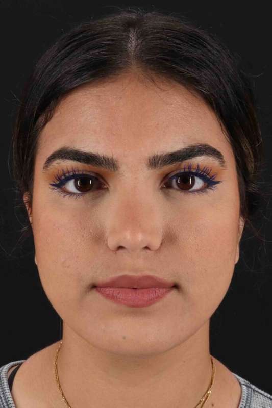 Rhinoplasty Before & After Patient #5958