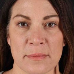 Rhinoplasty Before & After Patient #5969