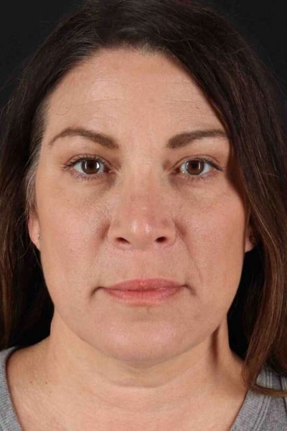 Rhinoplasty Before & After Patient #5969