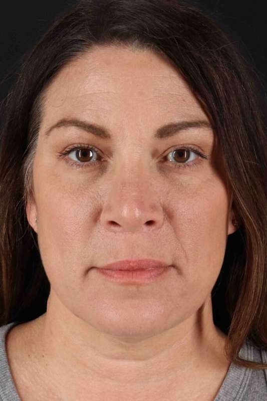Rhinoplasty Before & After Patient #5969