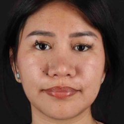Rhinoplasty Before & After Patient #5983