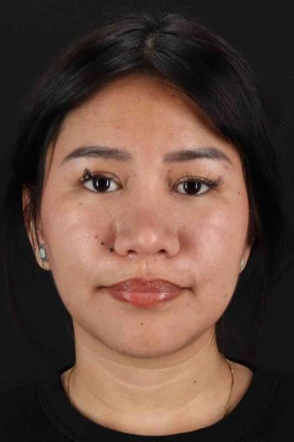 Rhinoplasty Before & After Patient #5983