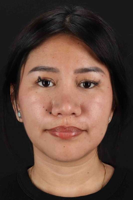 Rhinoplasty Before & After Patient #5983