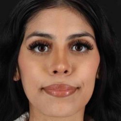 Rhinoplasty Before & After Patient #5994
