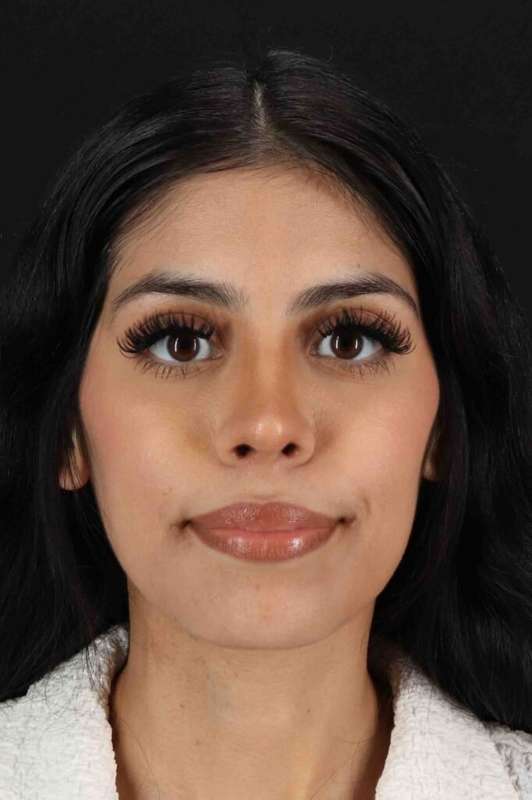Rhinoplasty Before & After Patient #5994