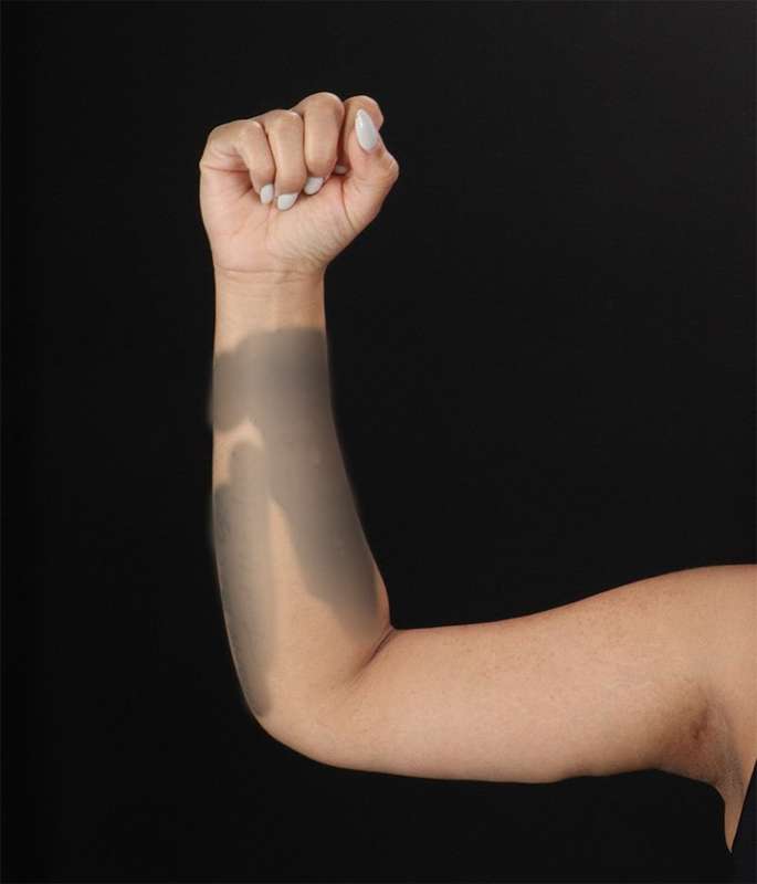 Brachioplasty (Arm Lift) Before & After Patient #1150