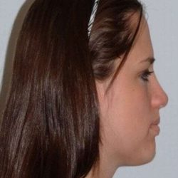 Rhinoplasty Before & After Patient #6008