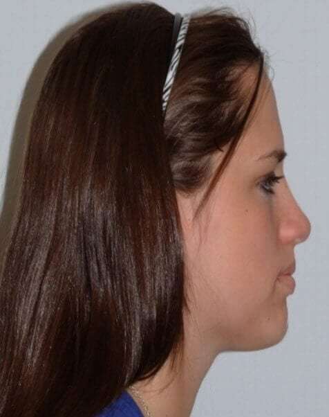 Rhinoplasty Before & After Patient #6008