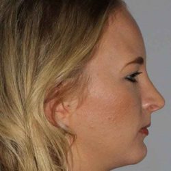 Rhinoplasty Before & After Patient #6011