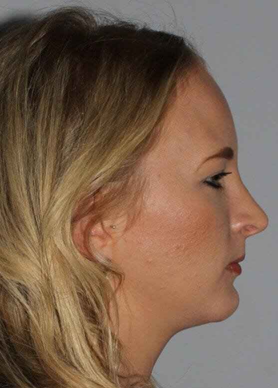 Rhinoplasty Before & After Patient #6011