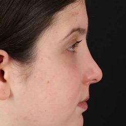 Rhinoplasty Before & After Patient #6014