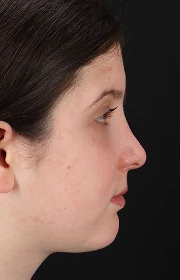Rhinoplasty Before & After Patient #6014