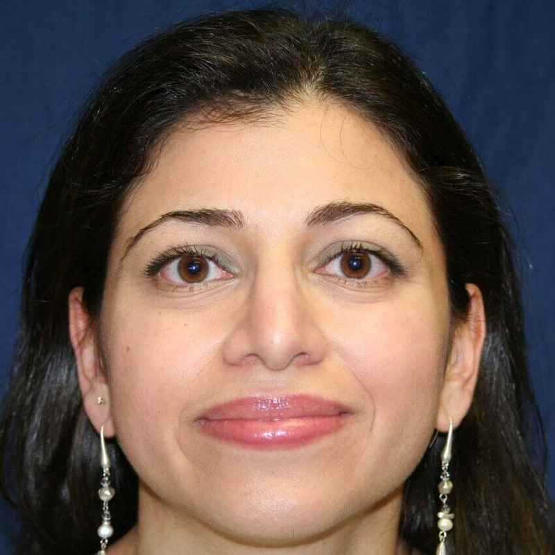 Rhinoplasty Before & After Patient #6021