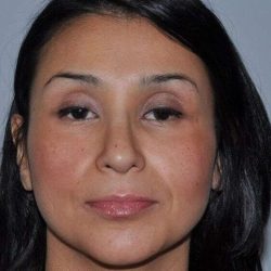 Rhinoplasty Before & After Patient #6035