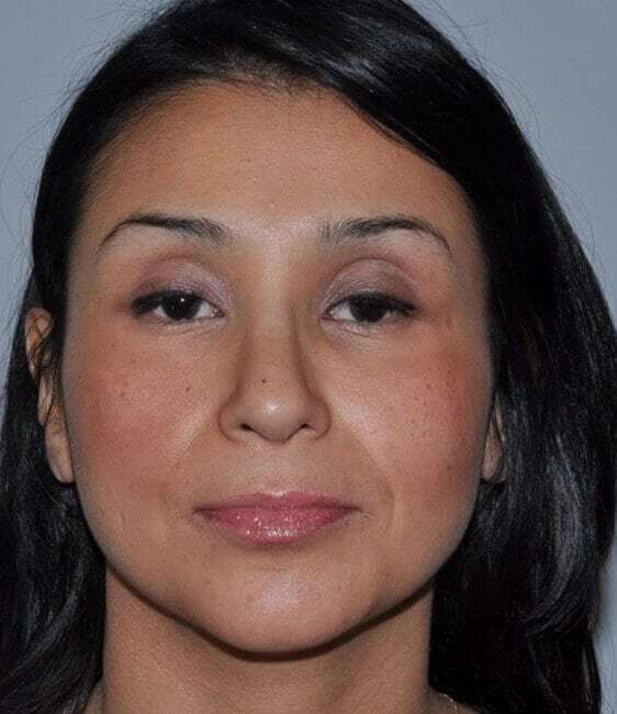 Rhinoplasty Before & After Patient #6035