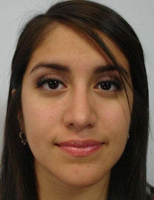 Rhinoplasty Before & After Patient #6040