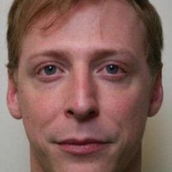 Rhinoplasty Before & After Patient #6047