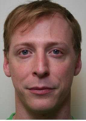 Rhinoplasty Before & After Patient #6047