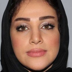 Rhinoplasty Before & After Patient #6054
