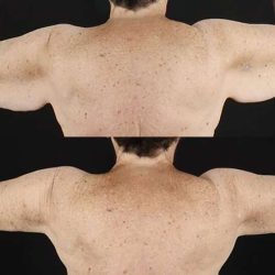 Brachioplasty (Arm Lift) Before & After Patient #1153