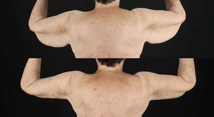 Brachioplasty (Arm Lift) Before & After Patient #1153