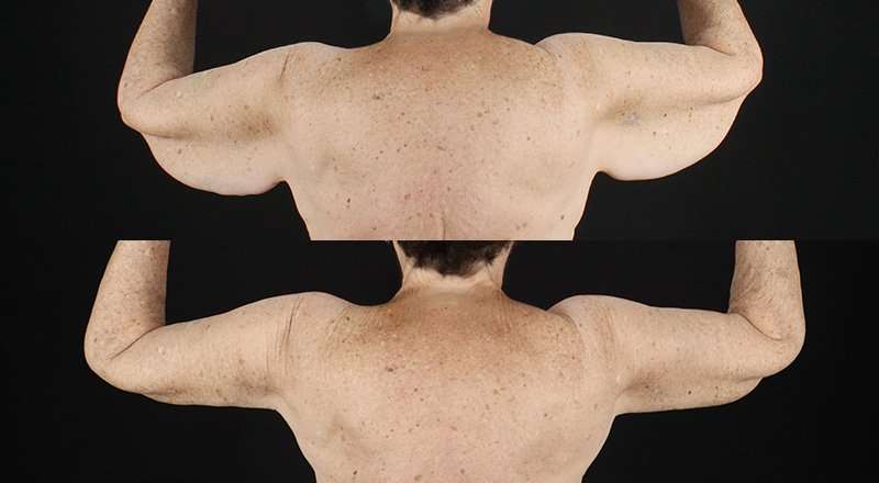 Brachioplasty (Arm Lift) Before & After Patient #1153