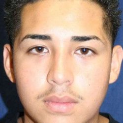 Rhinoplasty Before & After Patient #6068