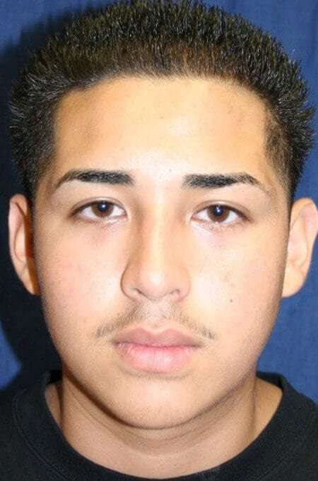 Rhinoplasty Before & After Patient #6068