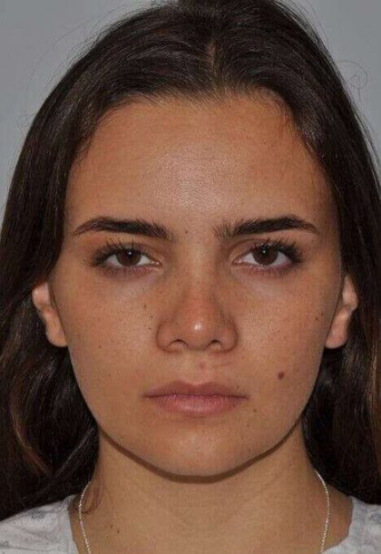 Rhinoplasty Before & After Patient #6075
