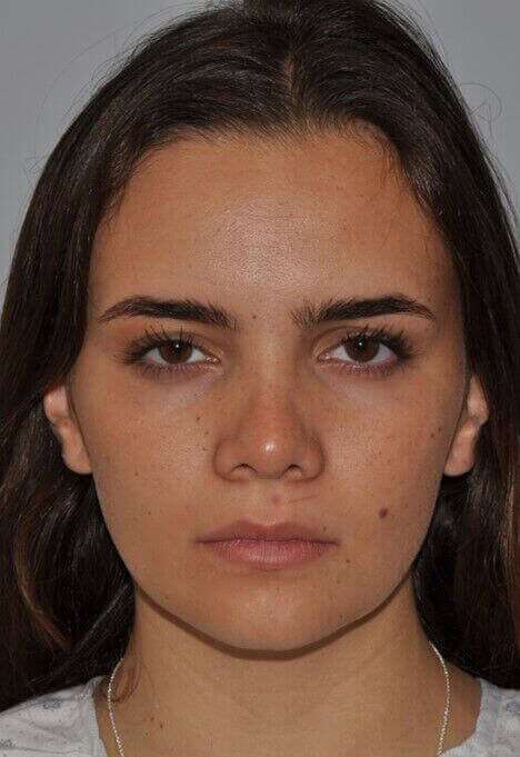 Rhinoplasty Before & After Patient #6075