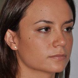 Rhinoplasty Before & After Patient #6080