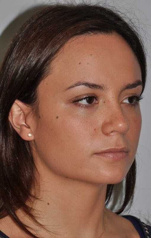 Rhinoplasty Before & After Patient #6080