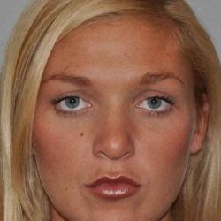Rhinoplasty Before & After Patient #6087