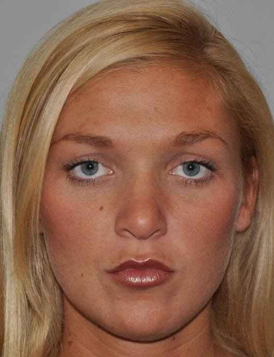 Rhinoplasty Before & After Patient #6087