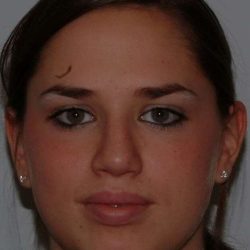 Rhinoplasty Before & After Patient #6092