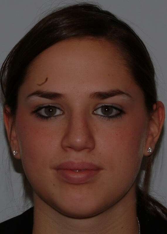 Rhinoplasty Before & After Patient #6092