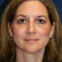 Rhinoplasty Before & After Patient #6099