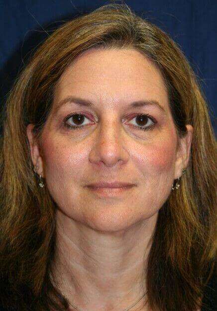 Rhinoplasty Before & After Patient #6099
