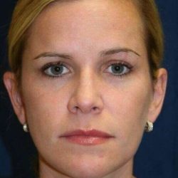 Rhinoplasty Before & After Patient #6106