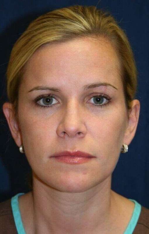 Rhinoplasty Before & After Patient #6106