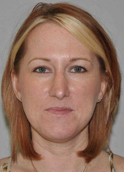 Rhinoplasty Before & After Patient #6120