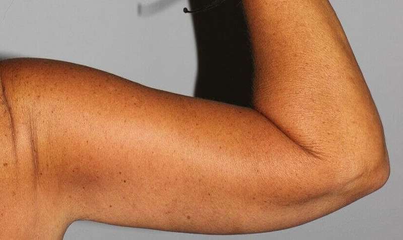 Brachioplasty (Arm Lift) Before & After Patient #1160