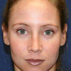 Rhinoplasty Before & After Patient #6132